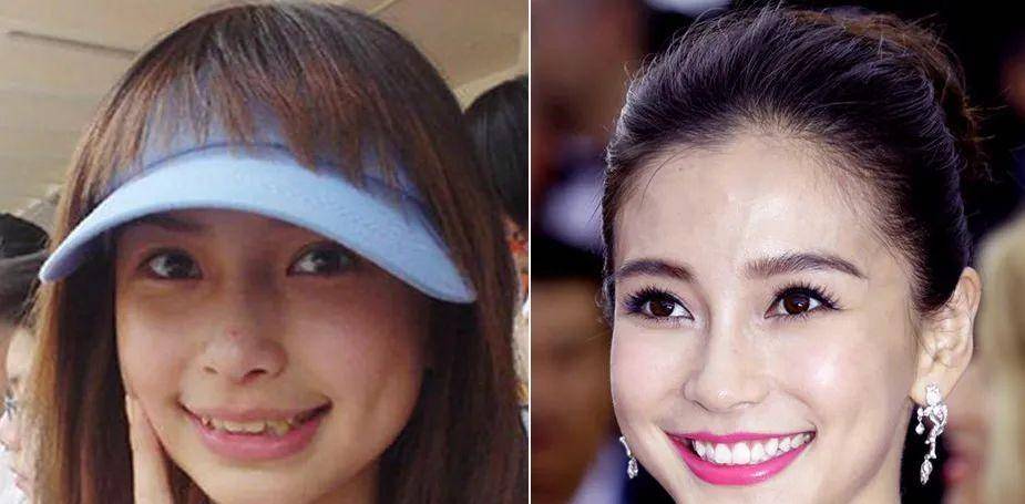 明星矯正牙齒之路，從過(guò)往經(jīng)歷看現(xiàn)代影響